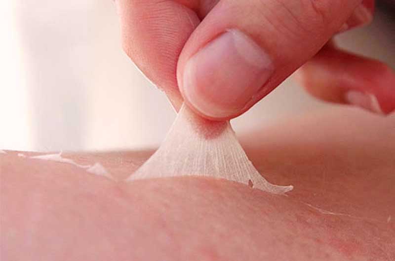 Sin necesidad de injertos, logran curar úlceras regenerando la piel