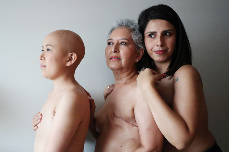 Una de cada 12 mujeres en el mundo desarrollará cáncer de mama, según la OMS