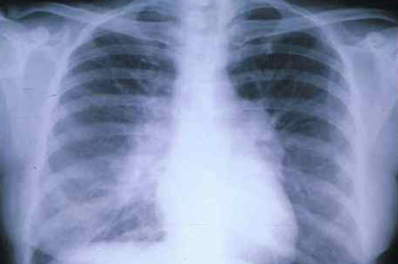 Fribosis pulmonar, una enfermedad con daños irreversibles