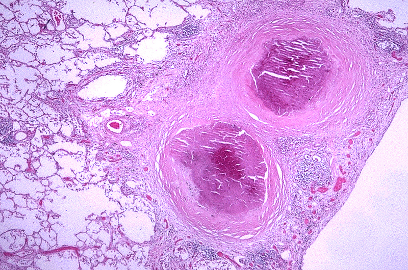 La histoplasmosis, enfermedad que proviene de los murciélagos y aves