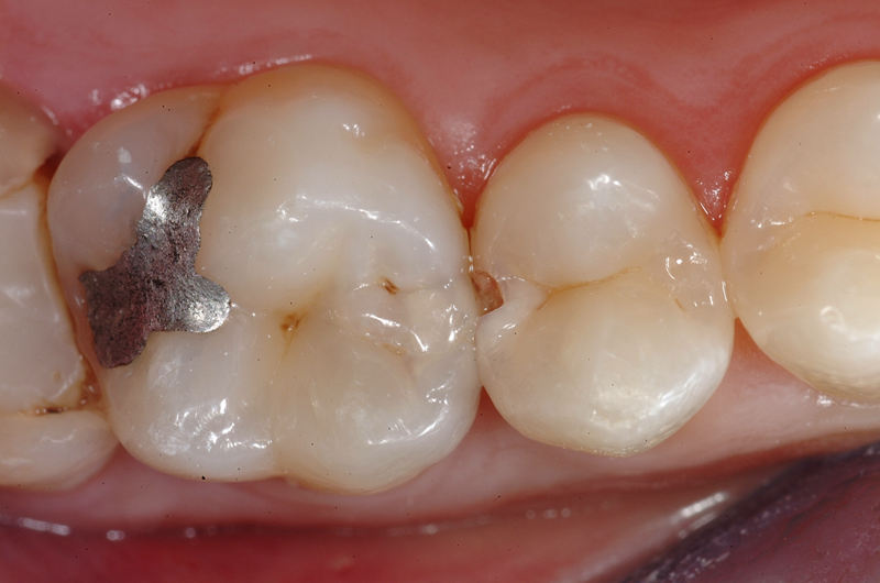 Caries, la principal causa de dolor en los dientes