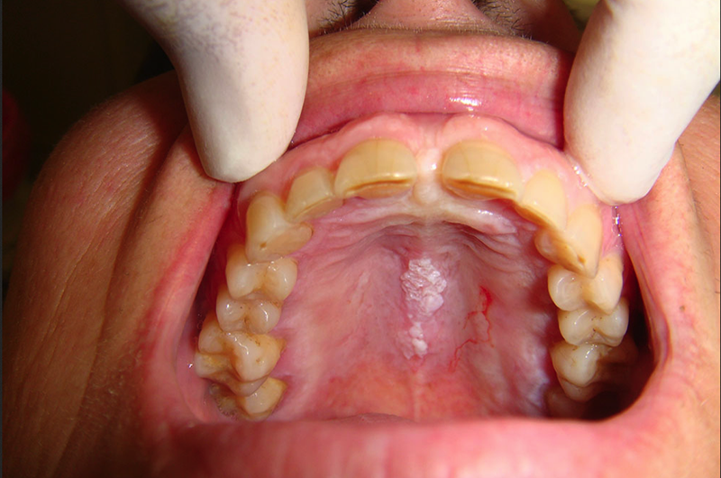 Cáncer bucal, un mal que los dentistas deberían diagnosticar
