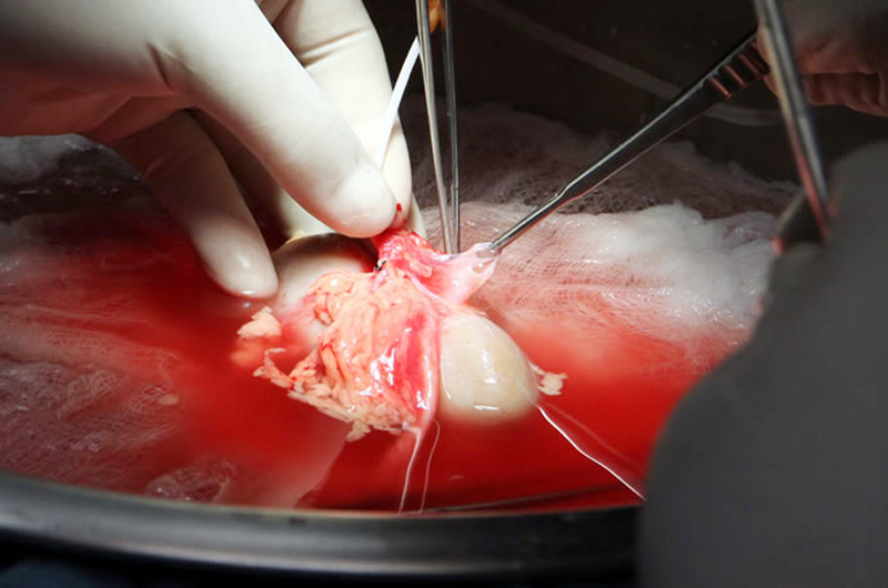 Trasplante de riñón de donante vivo mejora calidad de vida del paciente