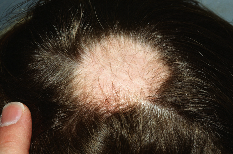 La de hombres jóvenes pierden cabello por estrés y hormonas | ElMundo.net